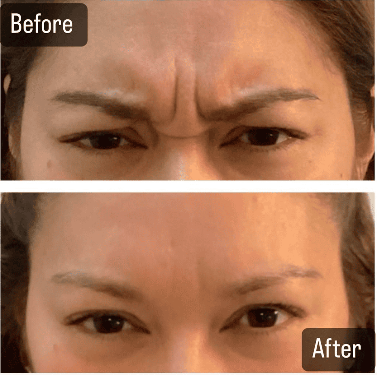 Forehead lines before/after – smoother after 2 weeks